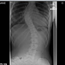 Scoliosis X-Ray
